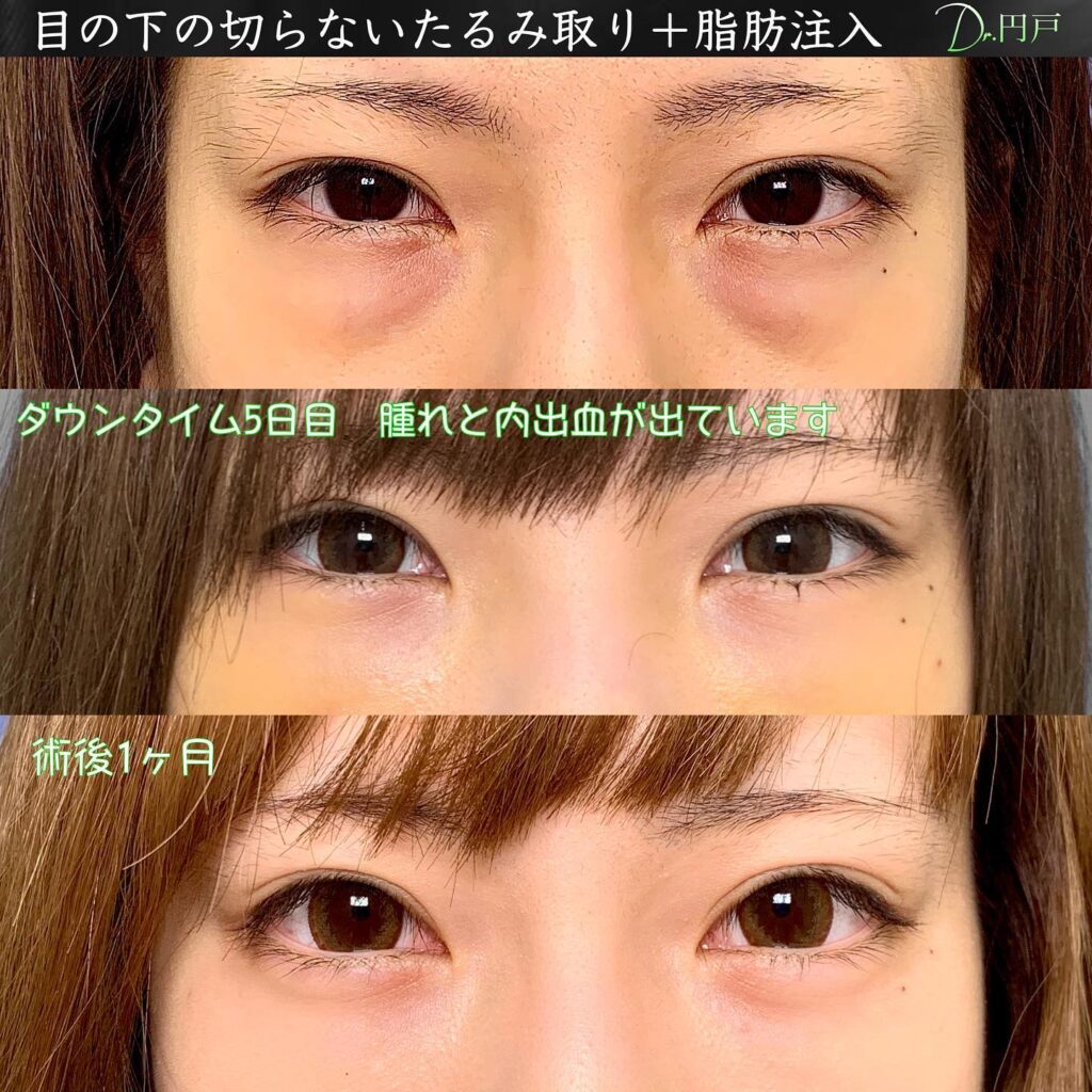 裏ハムラと脂肪注入の５日後と１か月後の症例写真-1024x1024