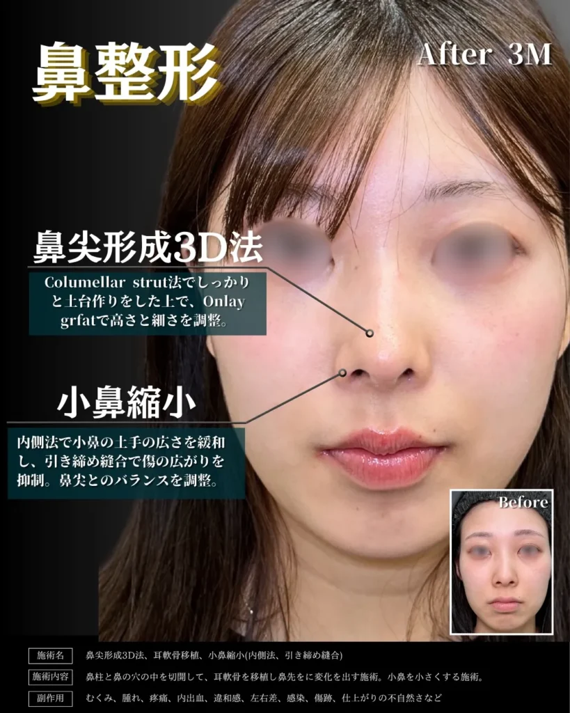 鼻整形_鼻尖形成3D法＋耳介軟骨移植＋小鼻縮小（内側法）（引き締め縫合）の症例