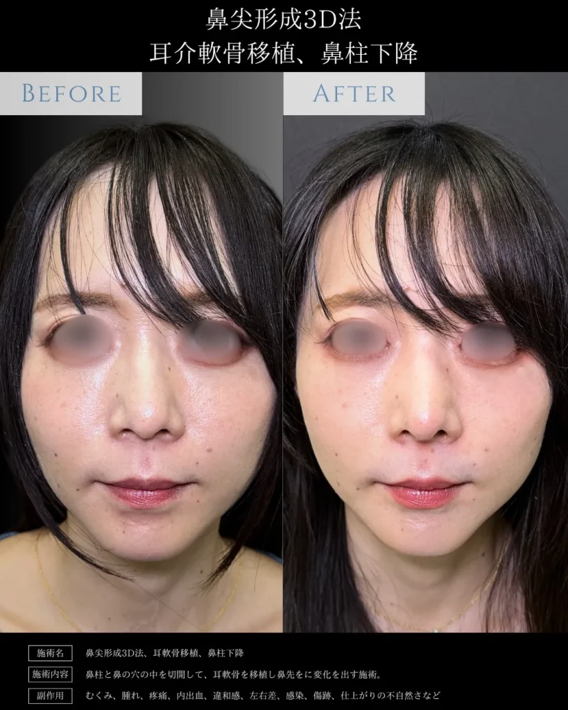 鼻整形_鼻尖形成3D法＋耳介軟骨移植＋鼻柱下降の症例