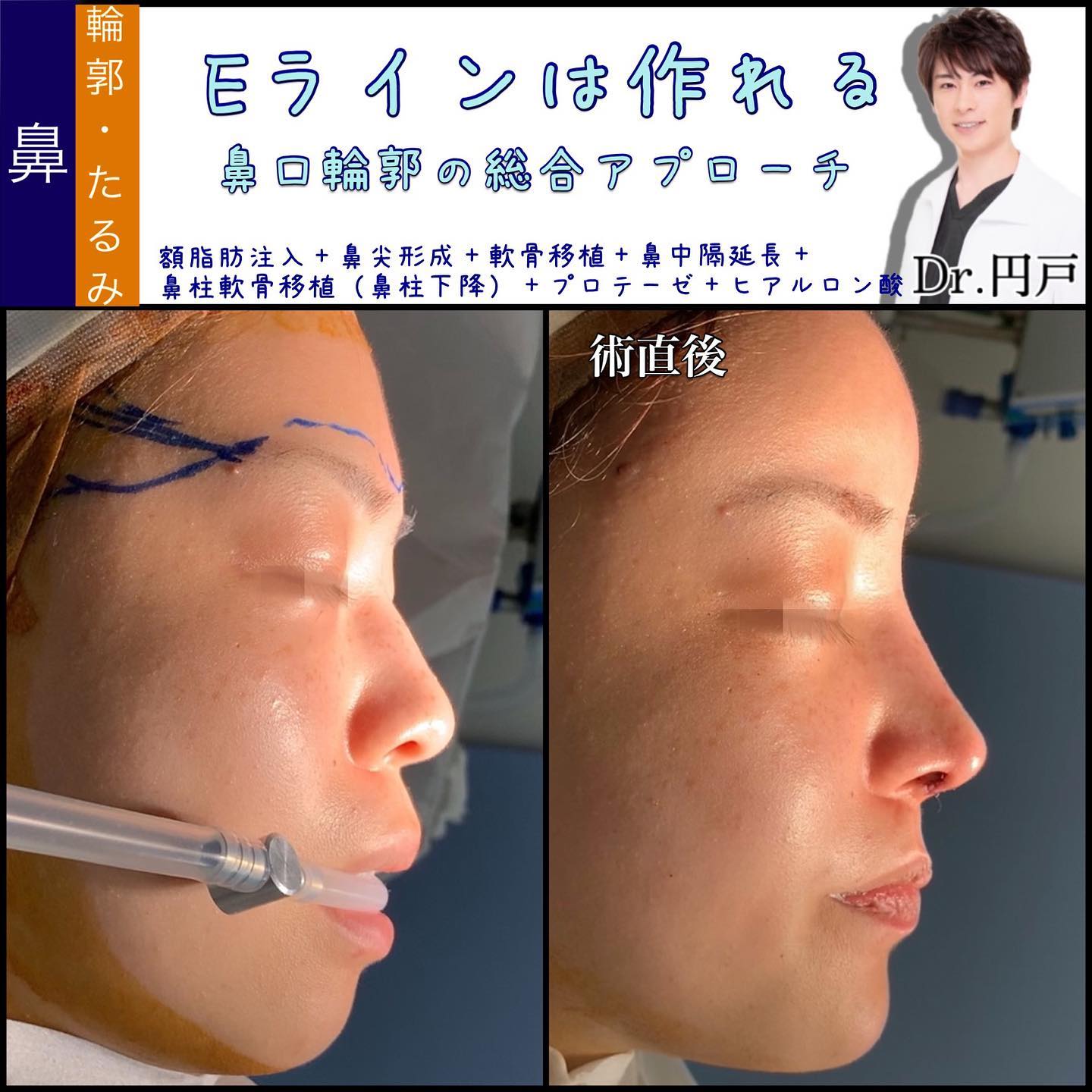 鼻尖形成＋軟骨移植＋鼻中隔延長とプロテーゼと鼻柱下降を同時に行った症例写真 (2)