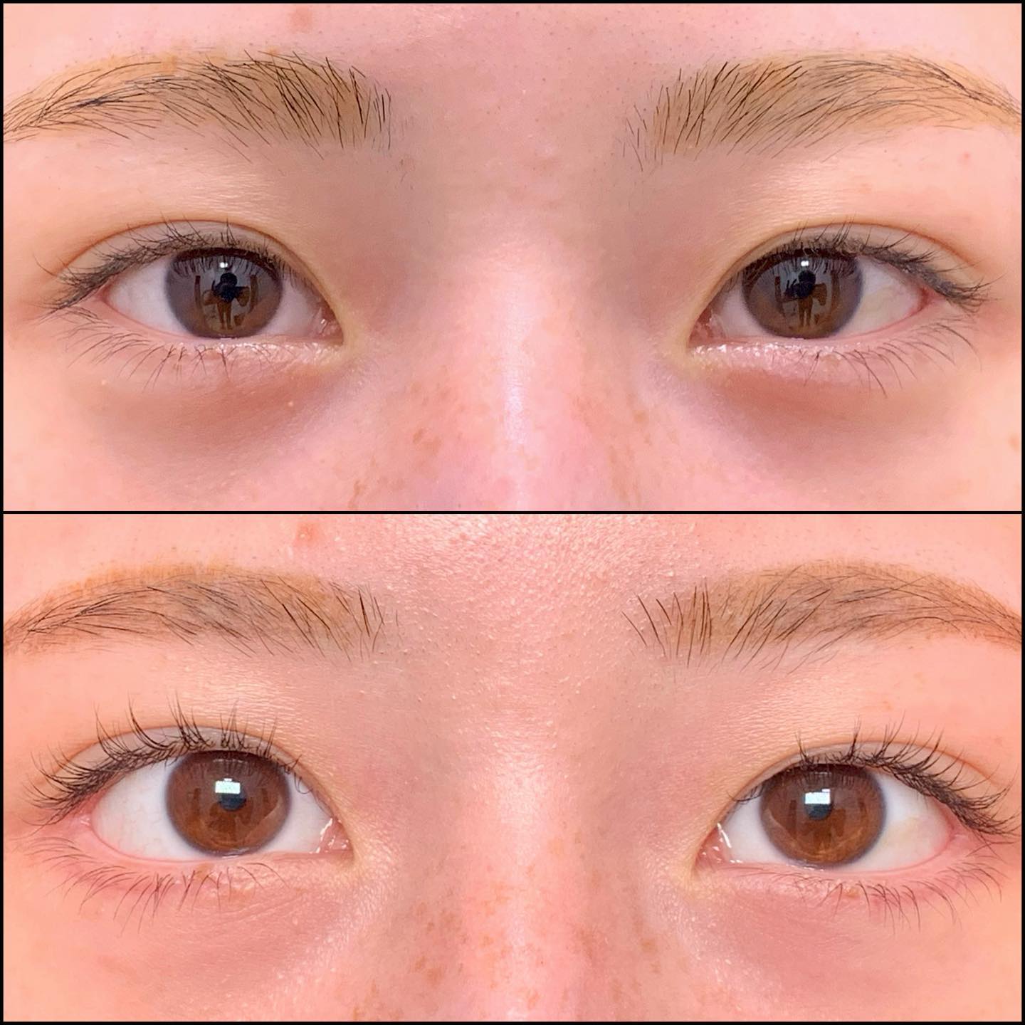 目尻切開とタレ目形成の他院修正の術後１ヶ月後の両目