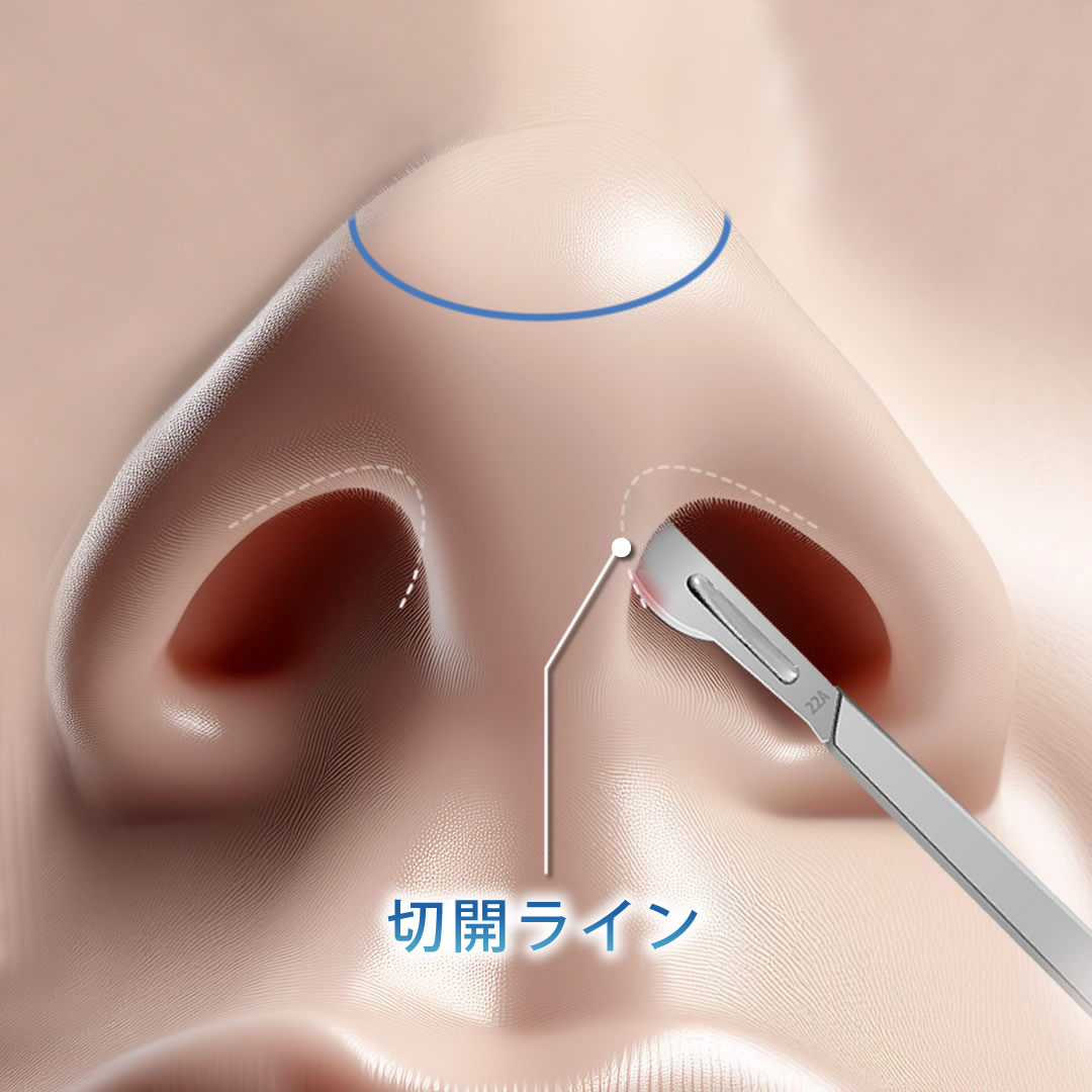 切開（クローズ法）