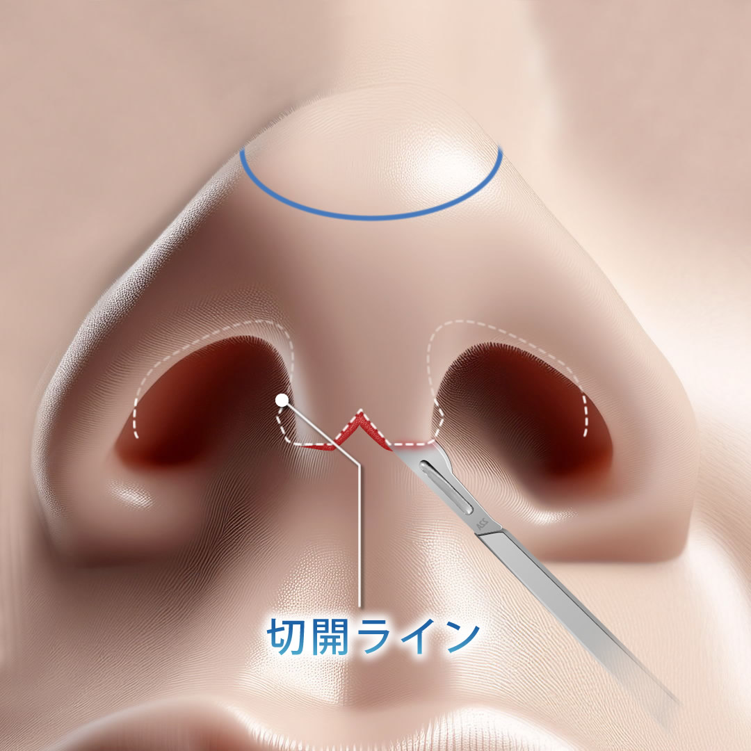 切開（オープン法）
