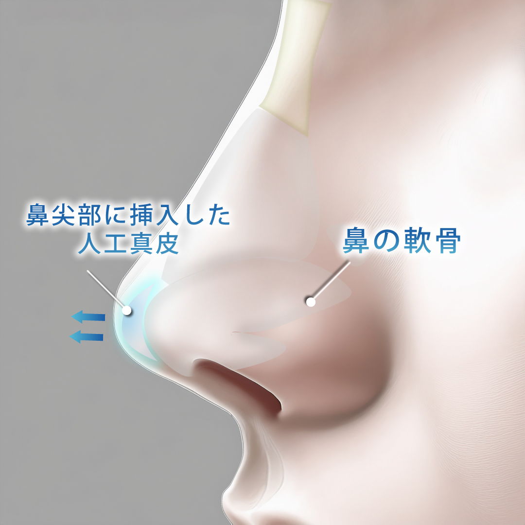 横から見た挿入後の鼻先
