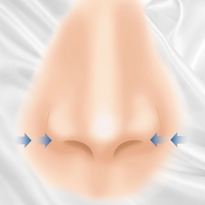 小鼻縮小術