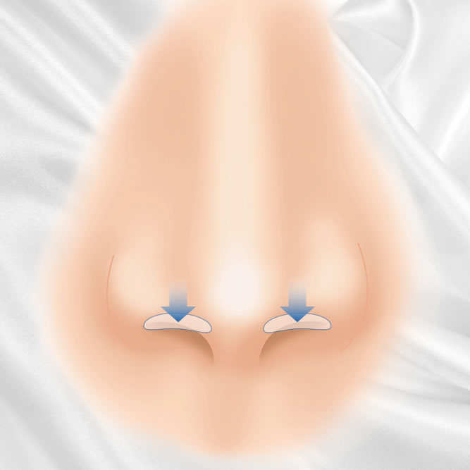 鼻孔縁下降術