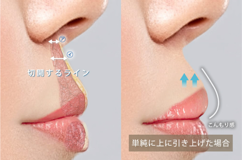 単純に唇を引き上げる場合のデメリットの説明図
