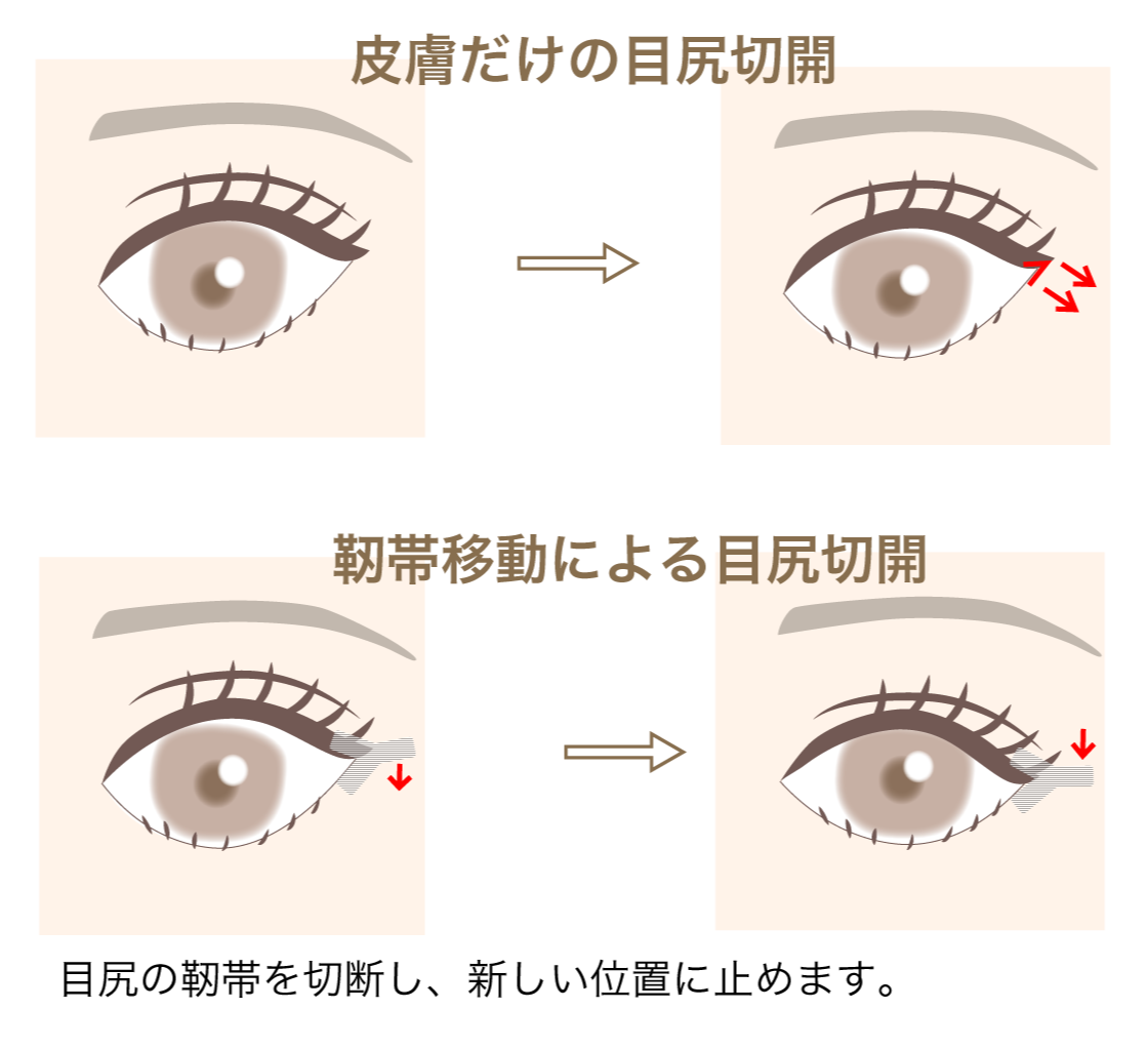 目尻切開 金沢 美容外科 Eクリニック 公式 埋没法 リップリフト リフトアップ
