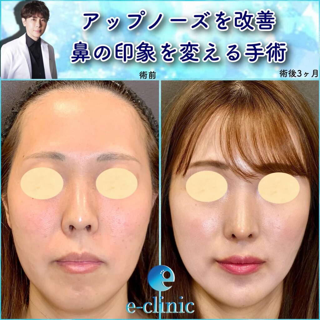 アップノーズを改善した鼻尖形成、軟骨移植、鼻中隔延長、口角挙上、顎ヒアルロン酸の症例