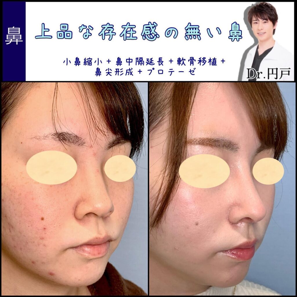 鼻尖形成、軟骨移植、鼻中隔延長、小鼻縮小、プロテーゼを同時に行った斜めから見た症例写真の図解