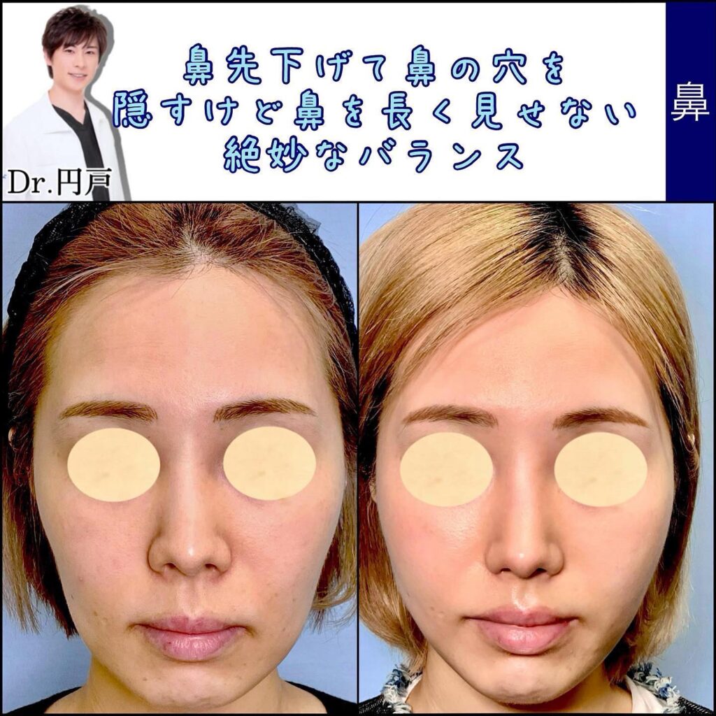 鼻中隔延長と鼻尖形成と鼻柱下降を同時に行った症例