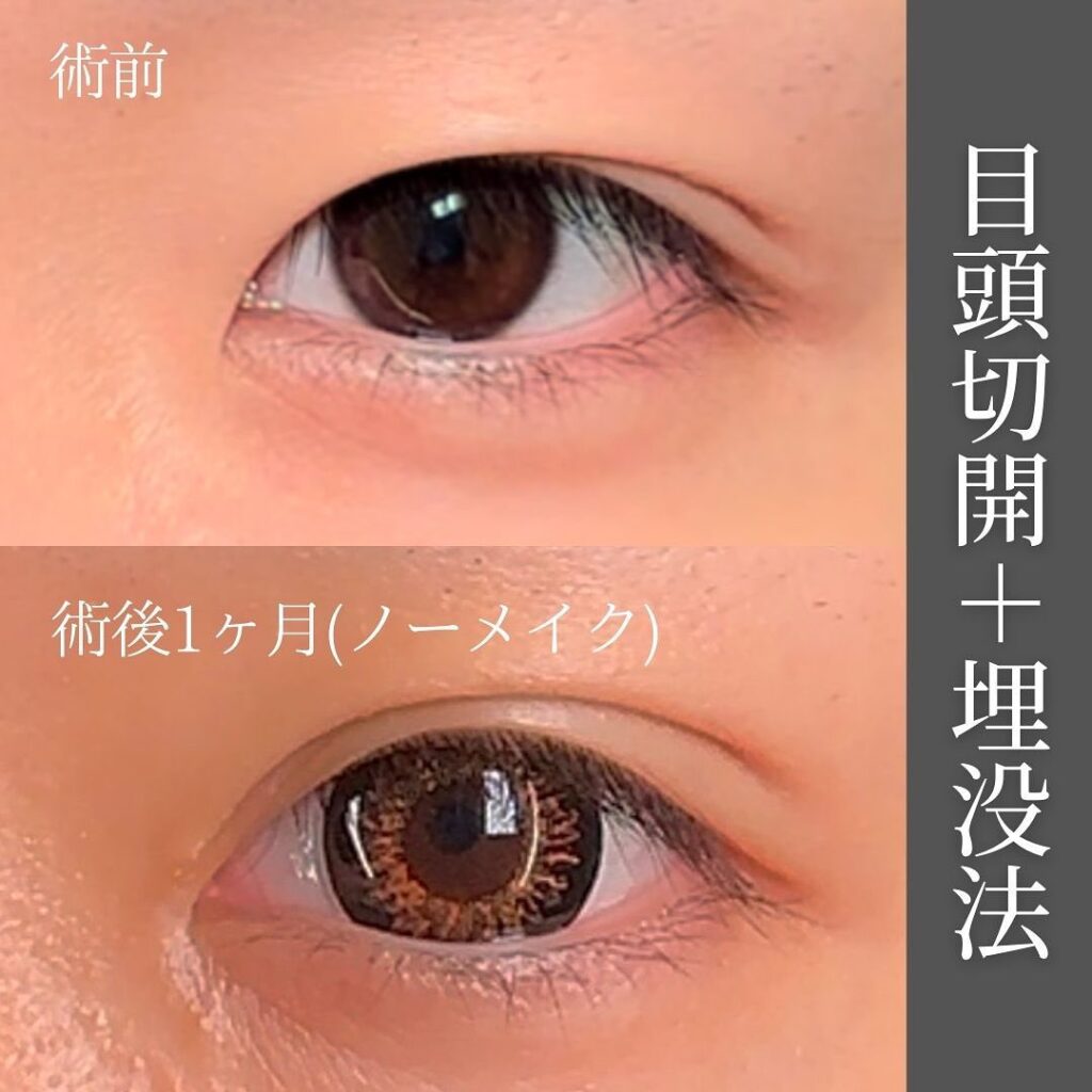 埋没法と目頭切開の症例写真 (2)