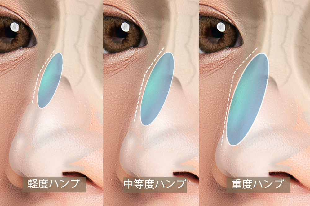 ハンプの程度の図解