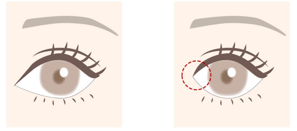 目頭形成の図解