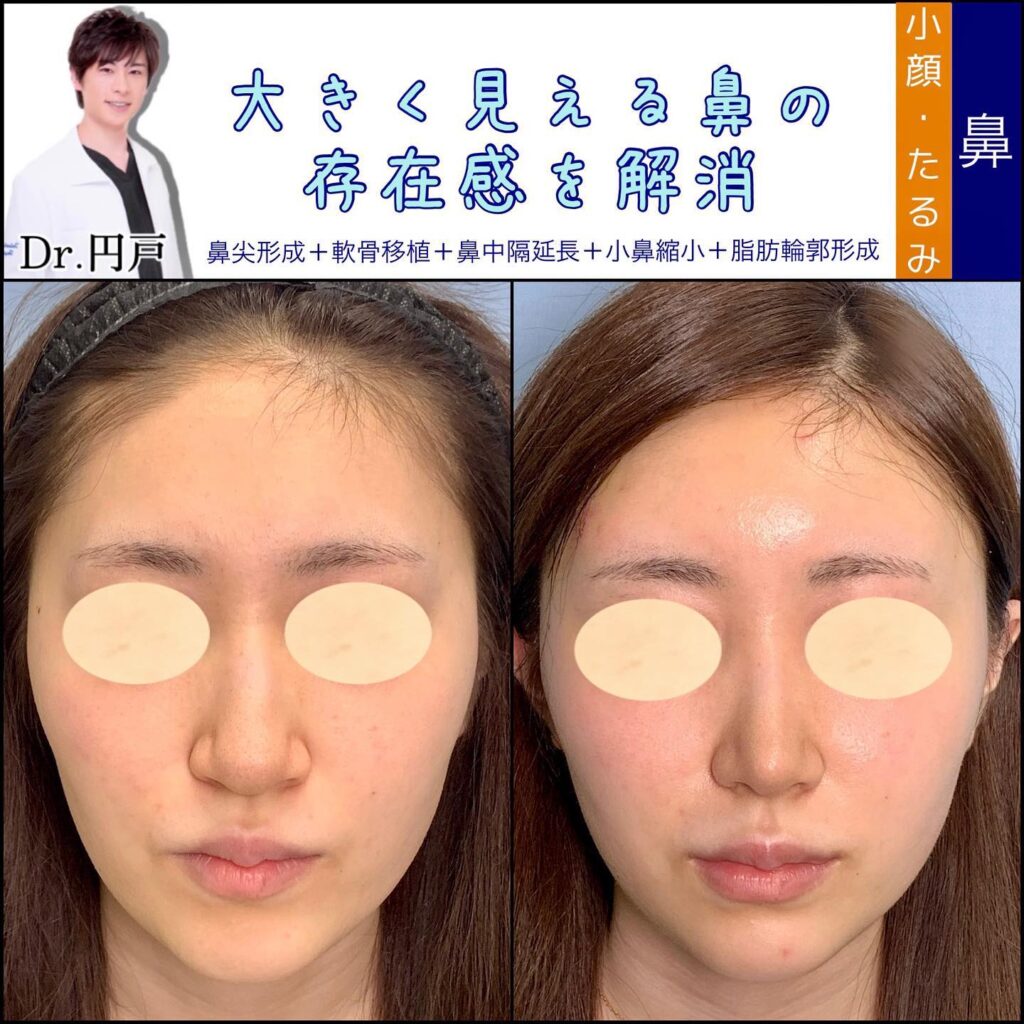 小鼻縮小と鼻尖形成を同時に行った症例 (2)