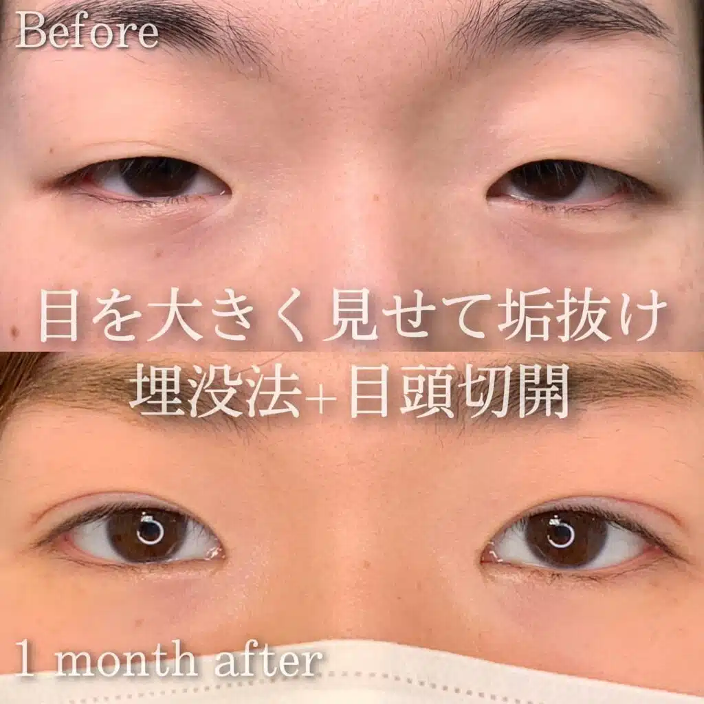 埋没　目頭切開