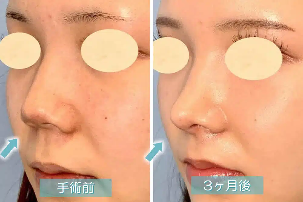 鼻唇角形成術(猫手術)