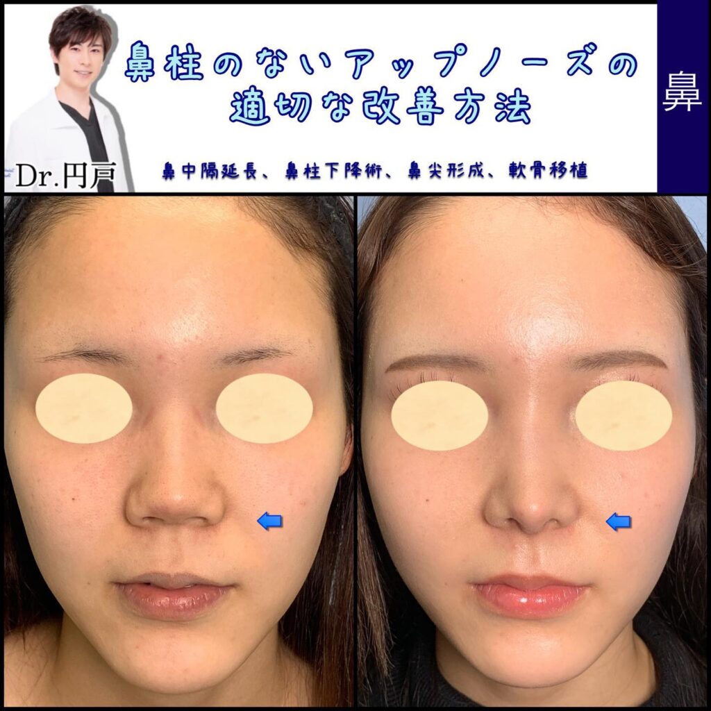 鼻柱下降と鼻尖形成と軟骨移植と鼻中隔延長で韓国風の鼻にした症例