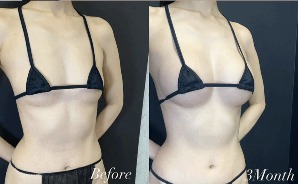 ハイブリッド豊胸の症例写真