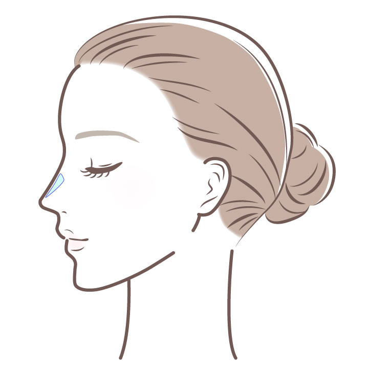 プロテーゼの挿入イメージ