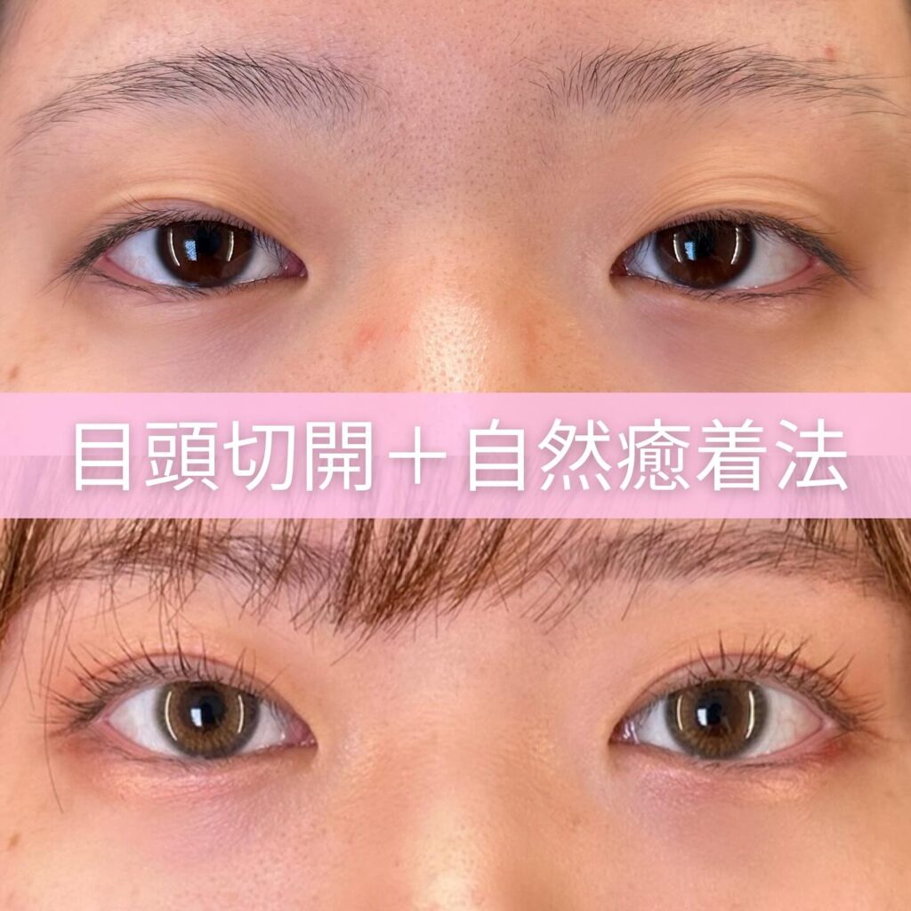 目頭切開と自然癒着法の症例写真