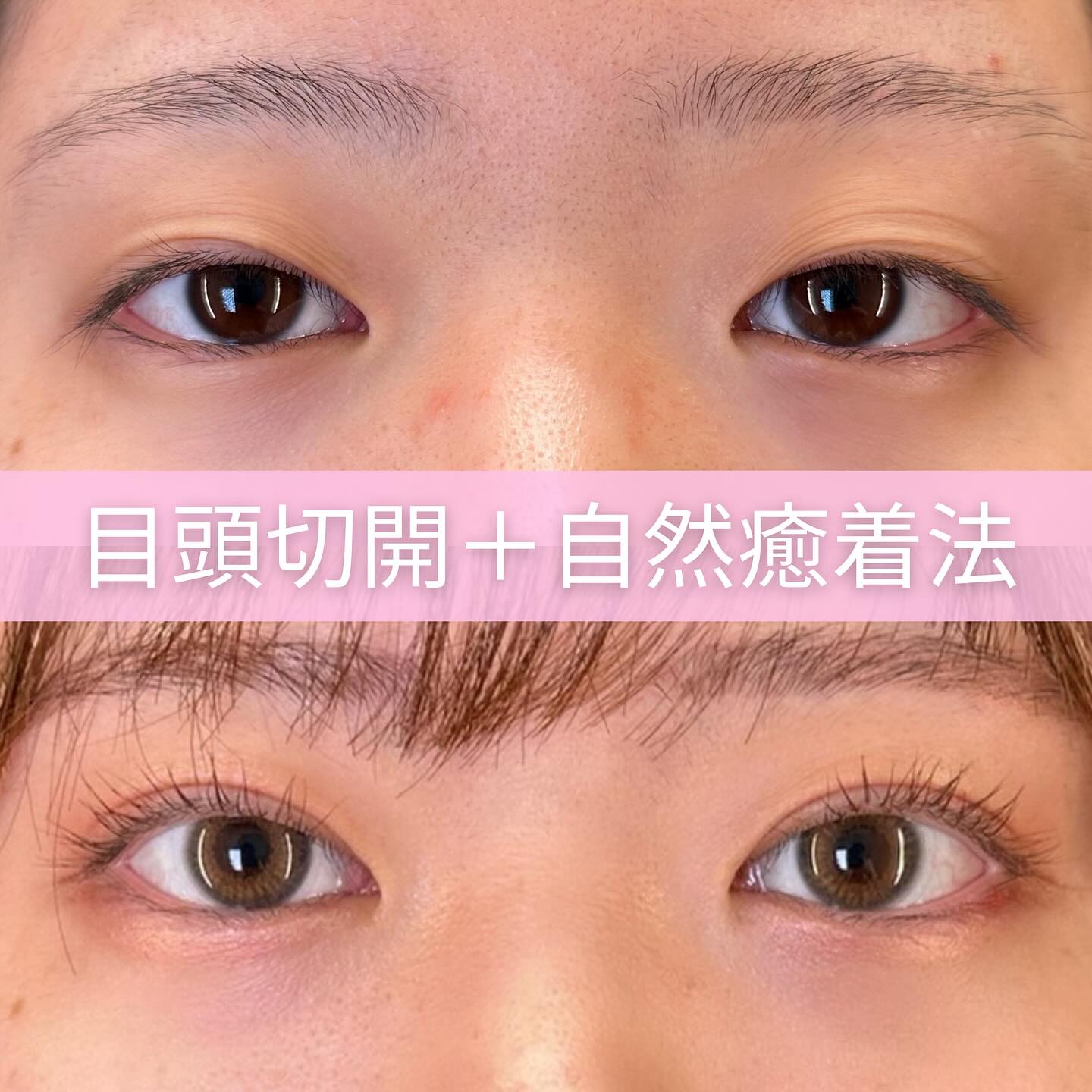 目頭切開と自然癒着法の症例写真