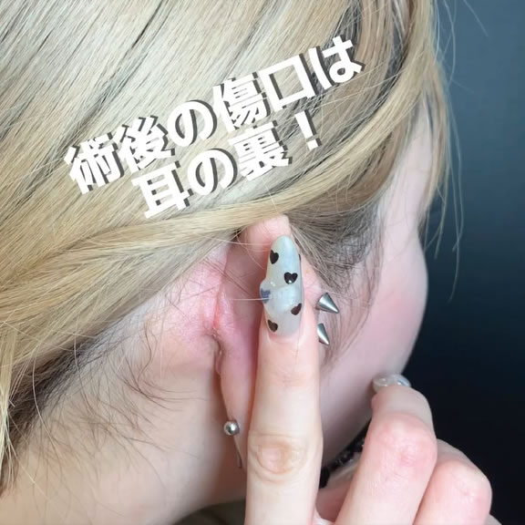eクリニックの耳軟骨移植の傷跡