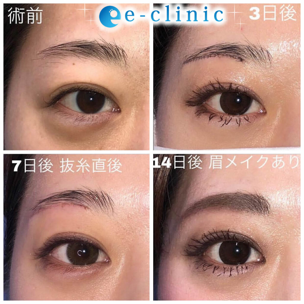 眉下切開の3日後と7日後と14日後の経過の症例