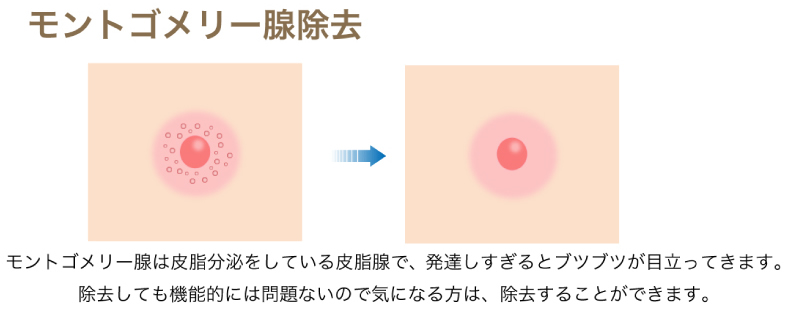 モントゴメリー腺除去の図解
