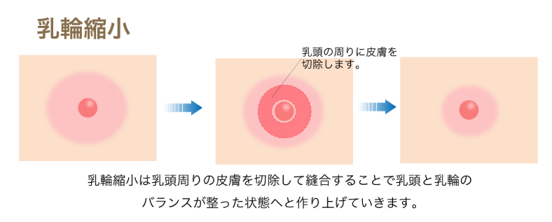 乳輪縮小の図解
