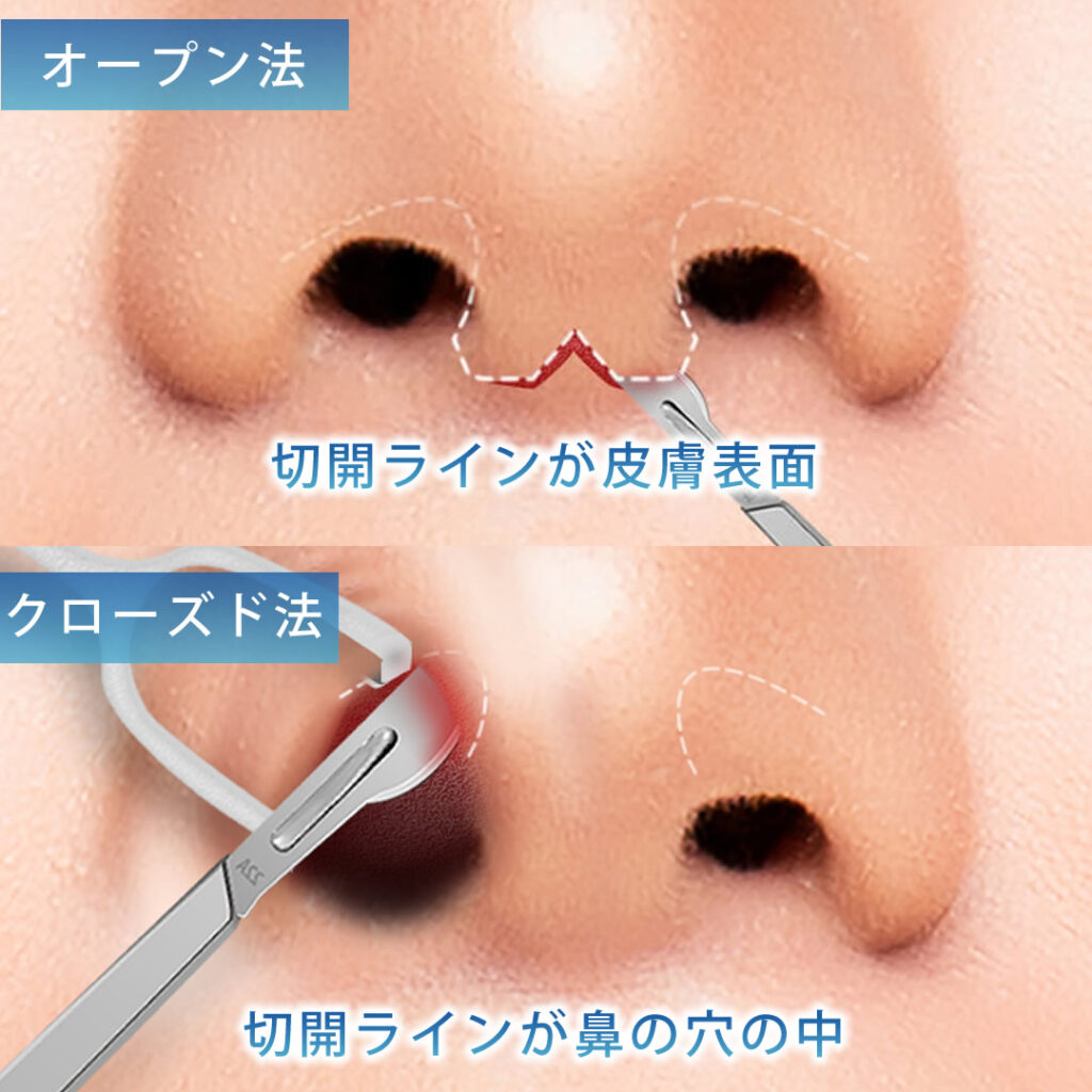 オープン法とクローズド法の切開ラインの比較