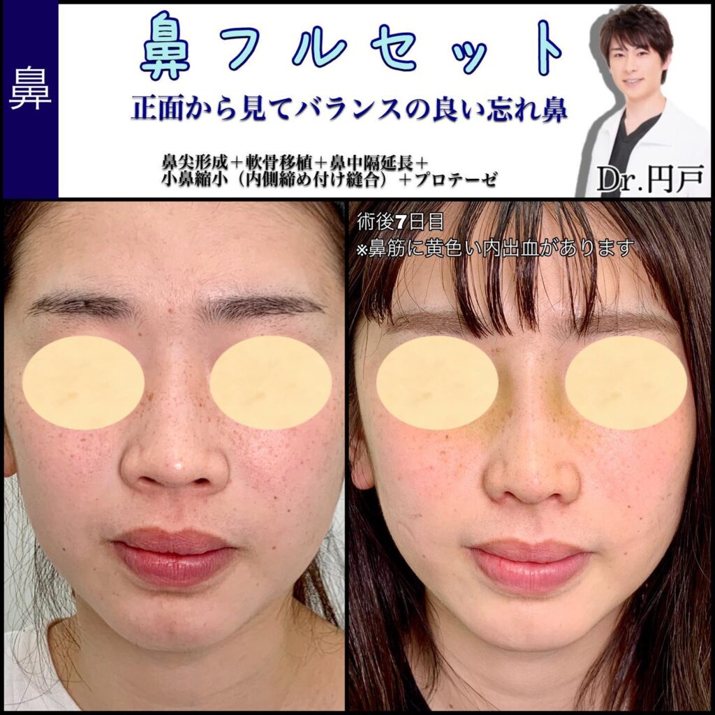 小鼻縮小と鼻尖形成を同時に行った症例 (1)