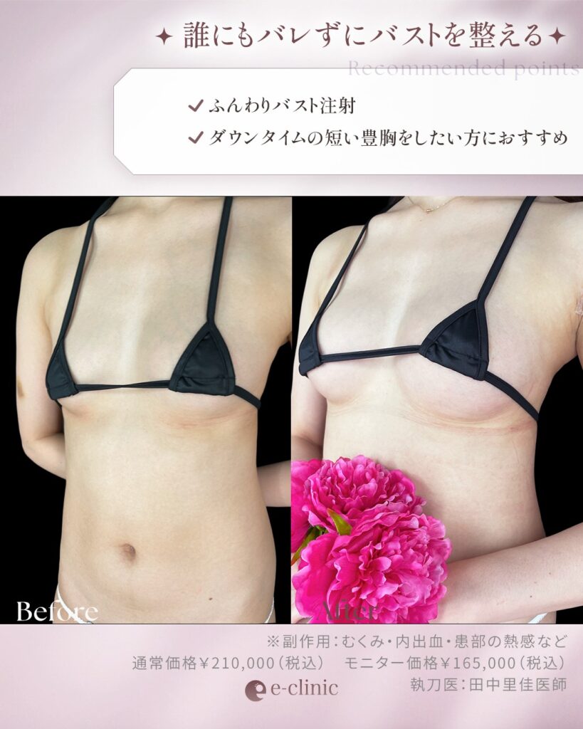 ふんわりバスト注射の症例写真