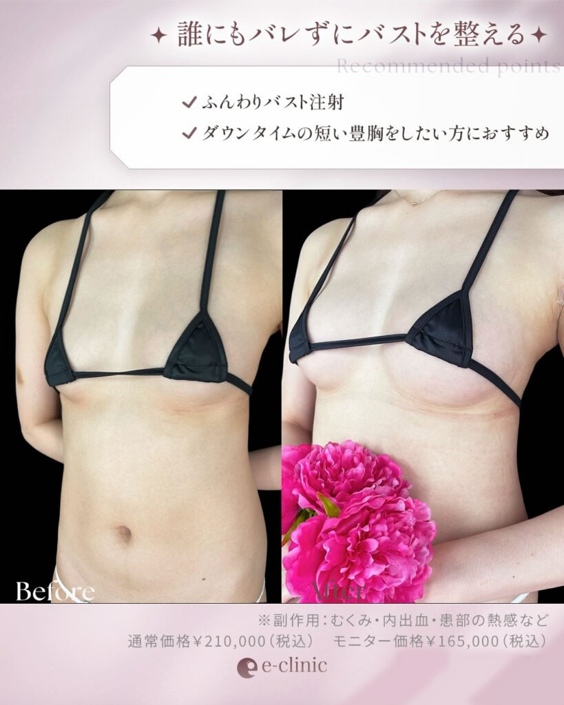 ふんわりバスト注射の症例写真