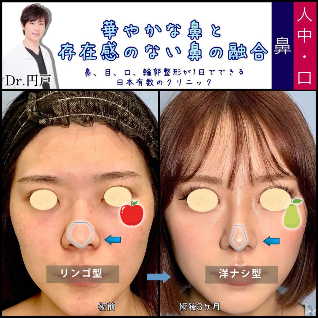 鼻中隔延長、軟骨移植、プロテーゼ、脂肪注入を同時に行いリンゴ型から洋ナシ型になった症例写真