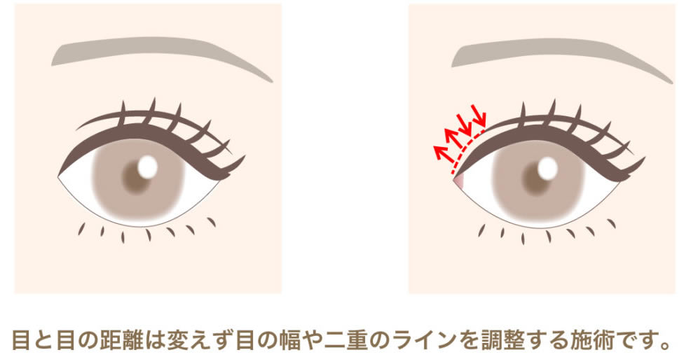 目上切開の図解