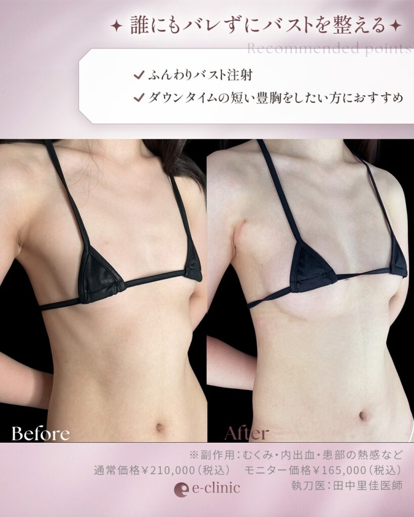 ふんわりバスト注射の症例写真