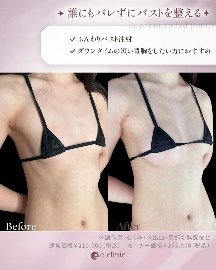 ふんわりバスト注射の症例写真
