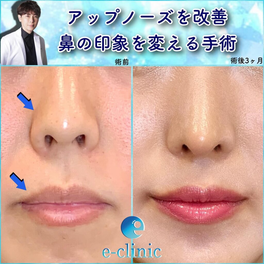 鼻尖形成、軟骨移植、鼻中隔延長、口角挙上、顎ヒアルロン酸の症例写真
