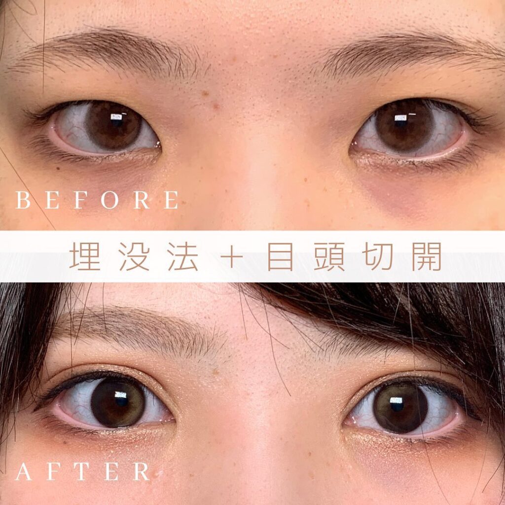 埋没法と目頭切開の症例写真 (1)