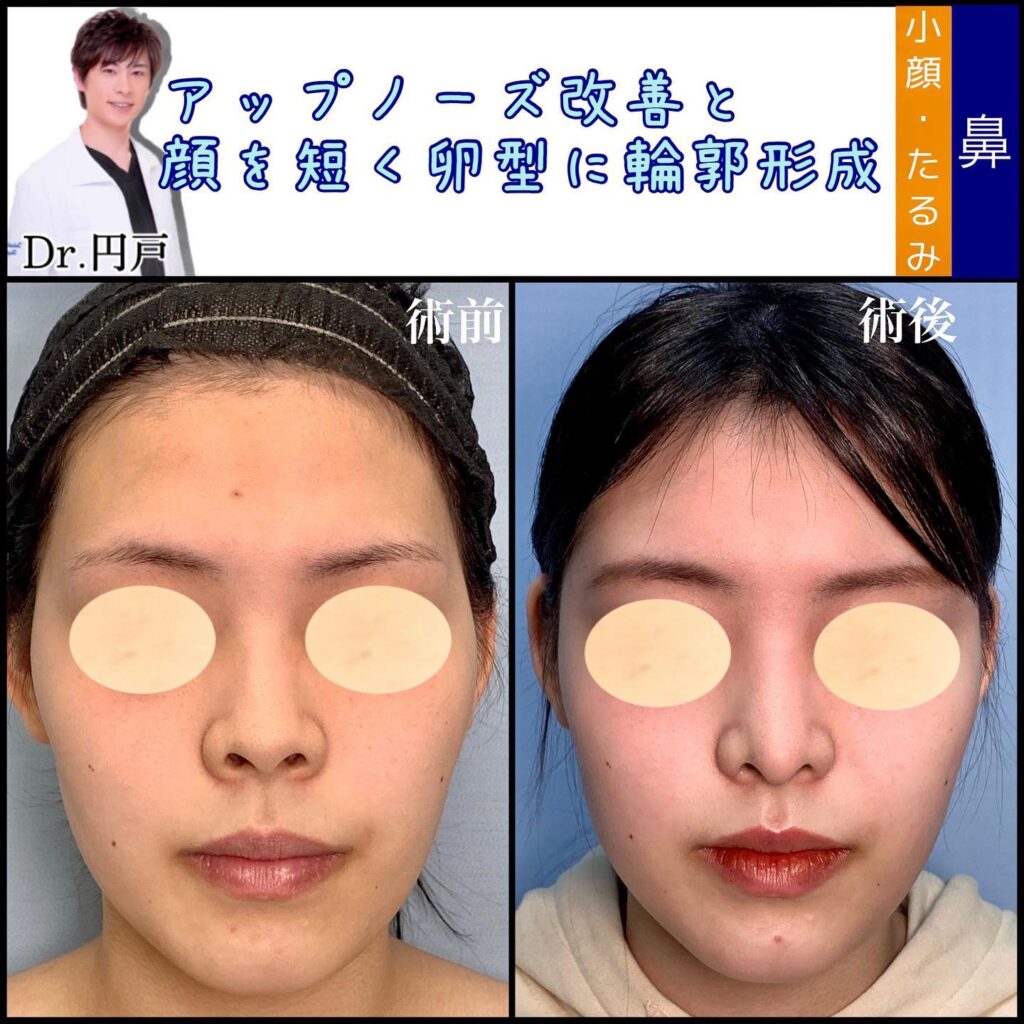 アップノーズを改善した症例