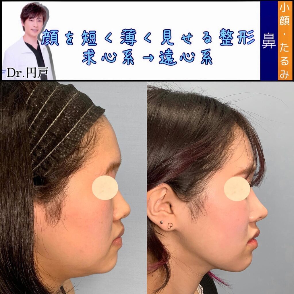 プロテーゼ、鼻尖形成、軟骨移植、鼻中隔延長を同時に行って正面から見た症例写真