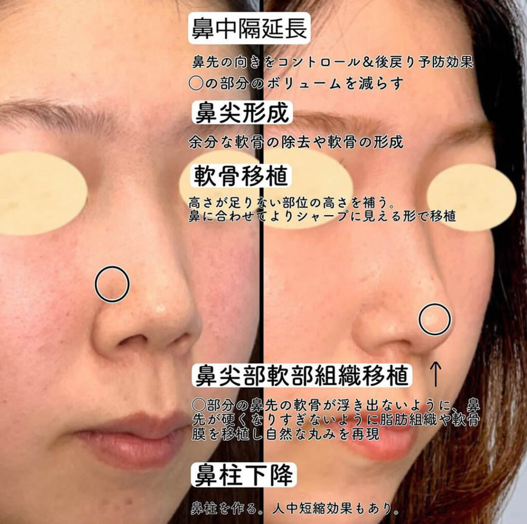 軟骨移植と鼻中隔延長と鼻柱下降の症例写真
