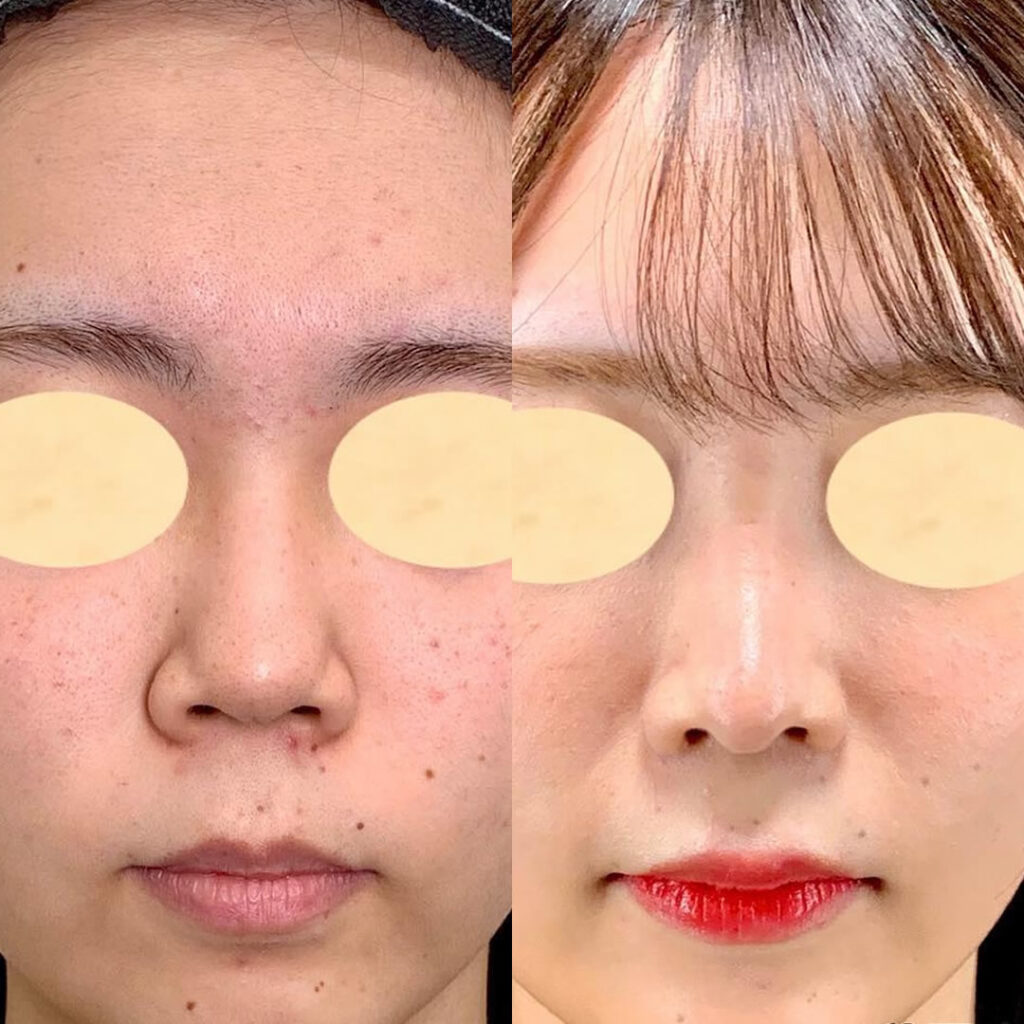 鼻のACRを改善した症例