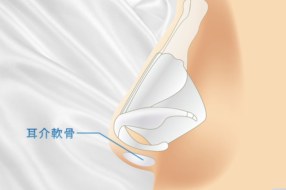 鼻柱に移植した耳介軟骨