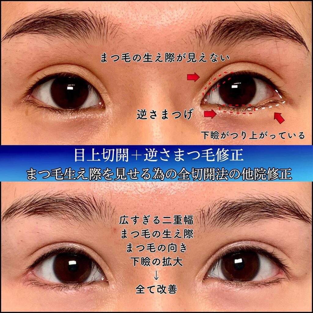 まつ毛を見えるようにした全切開の他院修正の症例の図解