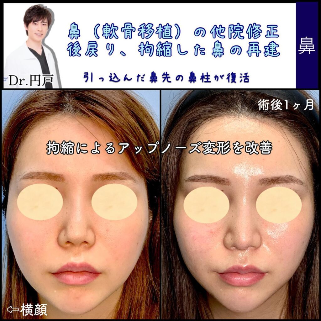 整形後に戻りしてしまった鼻の修正手術の1か月後の症例