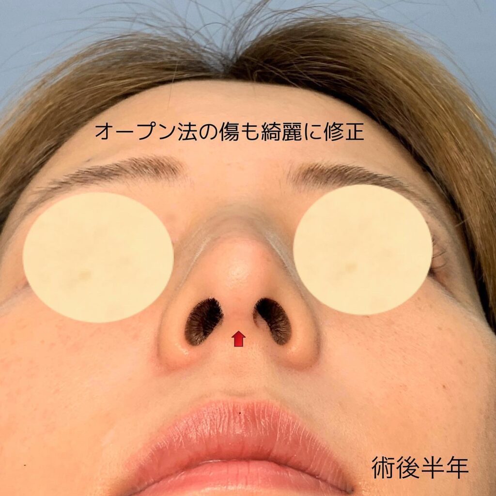 鼻の修正手術の傷跡