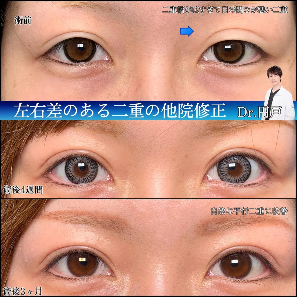 左右差のある全切開の他院修正
