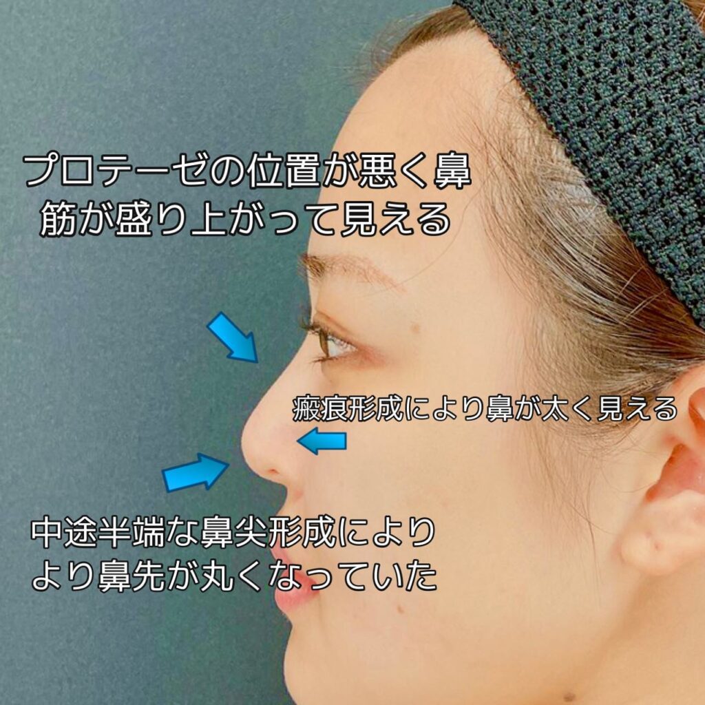 鼻の修正手術の図解